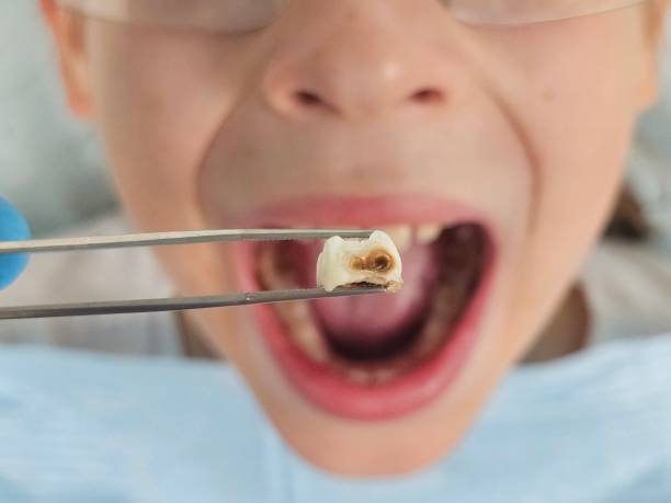 Best Emergency Treatment for Toothache in Deer Park, OH